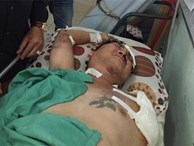 Ca sĩ Việt bị tai nạn mất cánh tay ở trong căn phòng 5 m2 